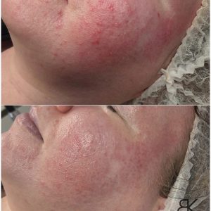 Profesjonalna terapia skóry naczyniowej i wrażliwej – mini zestaw zabiegowy